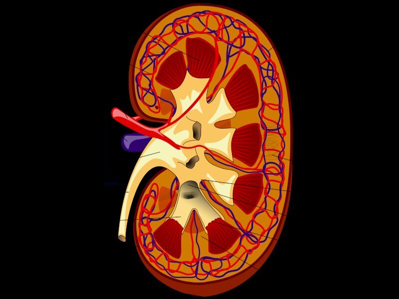 किडनी kidney stone